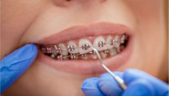 Cuidados para quem usa aparelho dentário