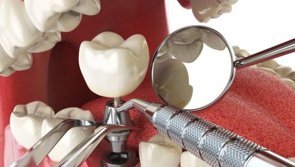 Implantes dentários: serão a melhor opção?